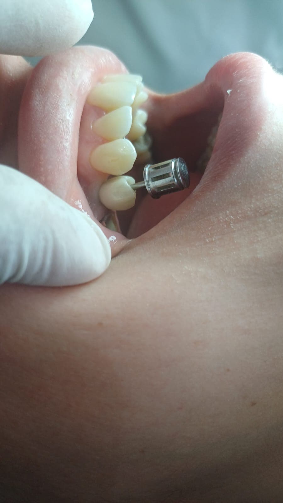 Transformation dentaire — cas 2