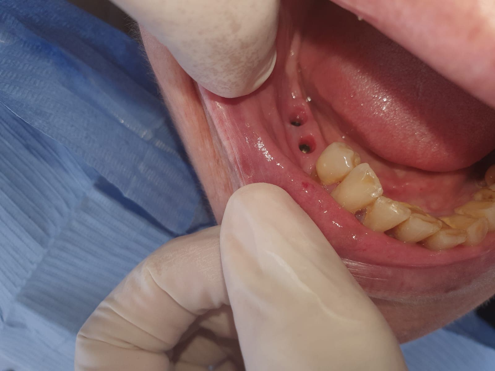 Transformation dentaire — cas 6